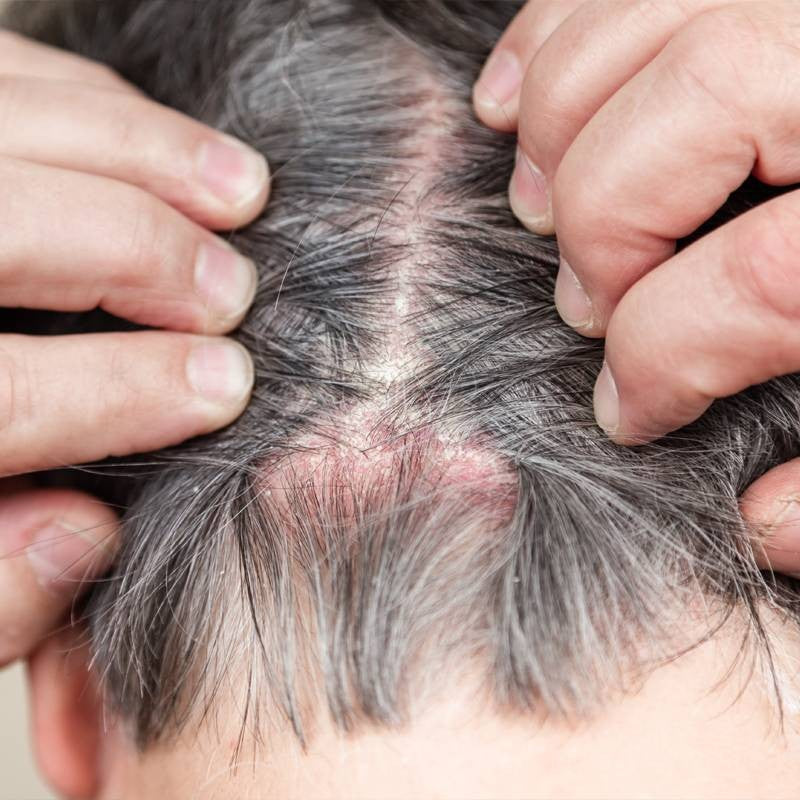Scalp